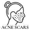 Acne Scars