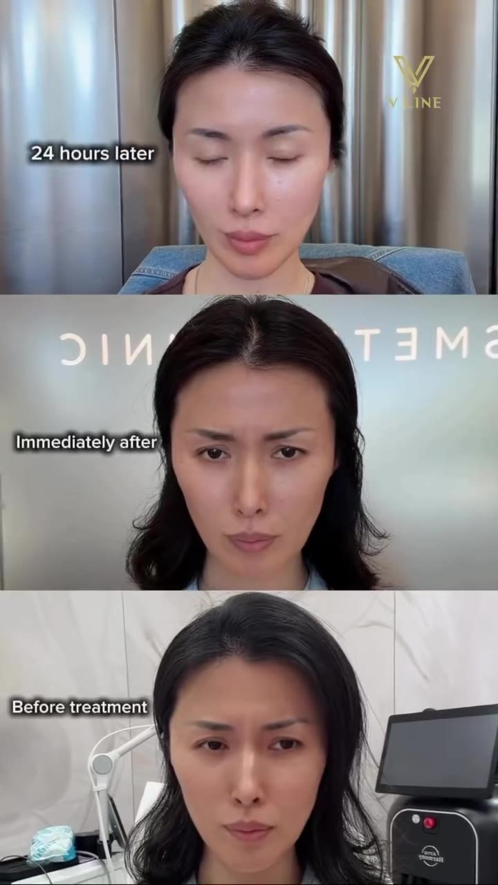 Why DAXXIFY? 🧬 @nurse_trinh Its peptide-powered formula helps deliver long-lasting muscle relaxation without using a human blood prote...