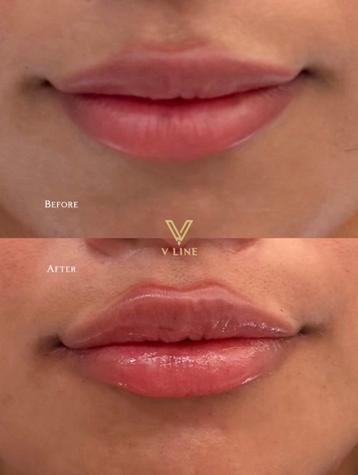 A little lip enhancement, a lot of artistry 💋 Beautifully balanced results by one of our master injectors. Ready to love your lips? Bo...