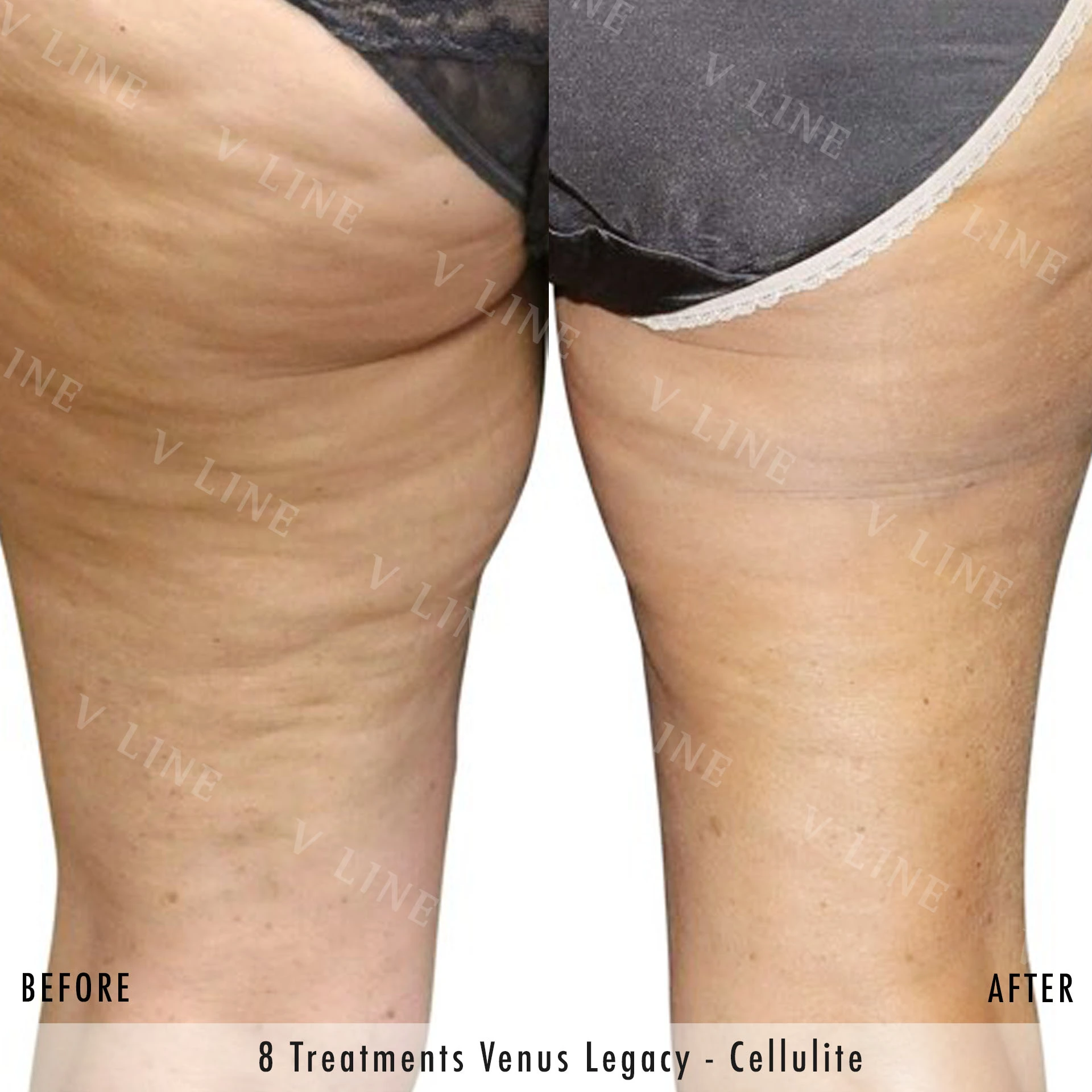 Venus Legacy Before & After Gallery - Patient 133236361 - Image 1